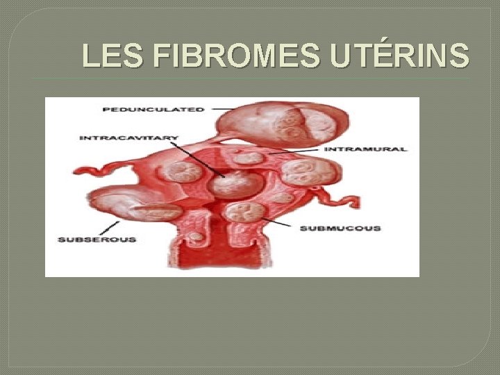 LES FIBROMES UTÉRINS 