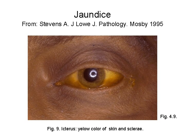 Jaundice From: Stevens A. J Lowe J. Pathology. Mosby 1995 Fig. 4. 9. Fig.