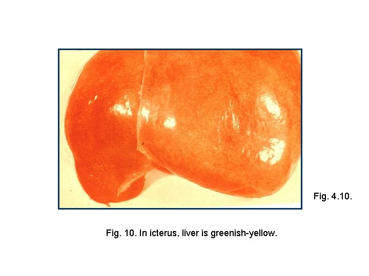 Fig. 4. 10. Fig. 10. In icterus, liver is greenish-yellow. 