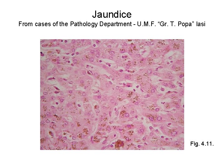 Jaundice From cases of the Pathology Department - U. M. F. “Gr. T. Popa”