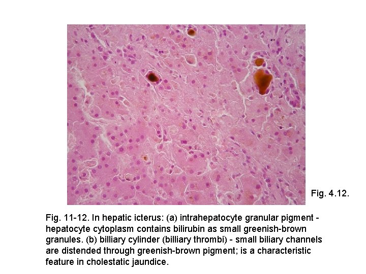 Fig. 4. 12. Fig. 11 -12. In hepatic icterus: (a) intrahepatocyte granular pigment hepatocyte