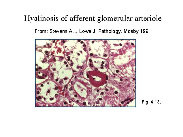 Hyalinosis of afferent glomerular arteriole From: Stevens A. J Lowe J. Pathology. Mosby 199