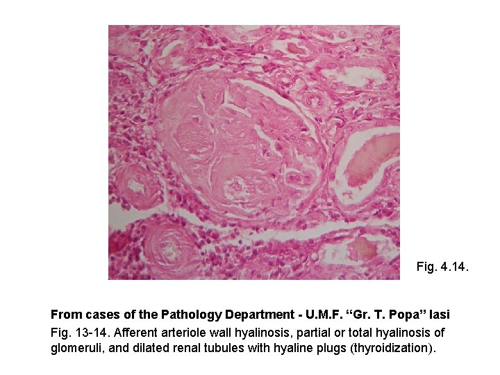 Fig. 4. 14. From cases of the Pathology Department - U. M. F. “Gr.