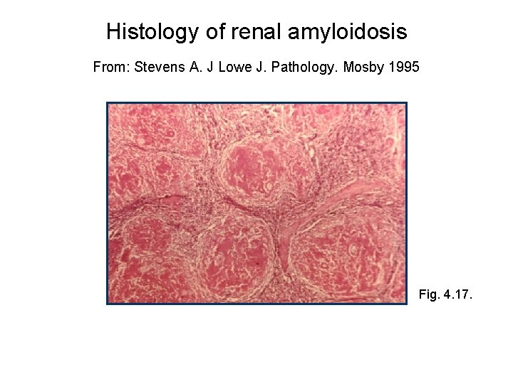 Histology of renal amyloidosis From: Stevens A. J Lowe J. Pathology. Mosby 1995 Fig.