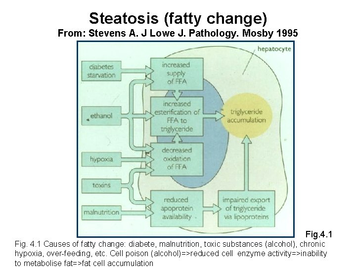 Steatosis (fatty change) From: Stevens A. J Lowe J. Pathology. Mosby 1995 Fig. 4.