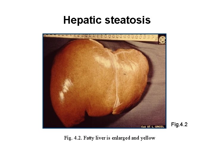 Hepatic steatosis Fig. 4. 2. Fatty liver is enlarged and yellow 