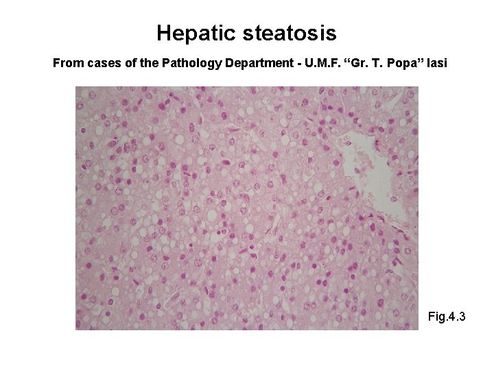 Hepatic steatosis From cases of the Pathology Department - U. M. F. “Gr. T.