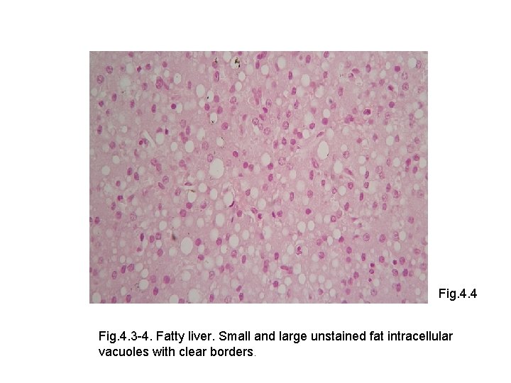 Fig. 4. 4 Fig. 4. 3 -4. Fatty liver. Small and large unstained fat