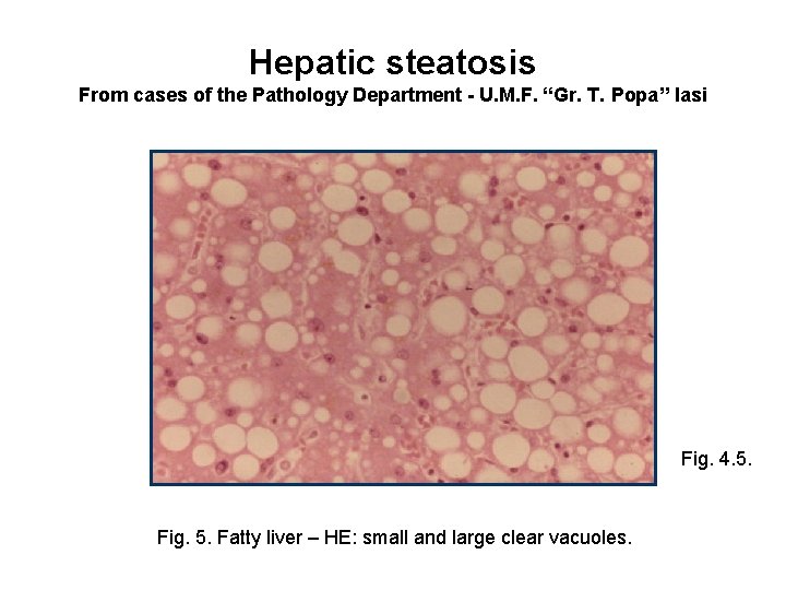 Hepatic steatosis From cases of the Pathology Department - U. M. F. “Gr. T.