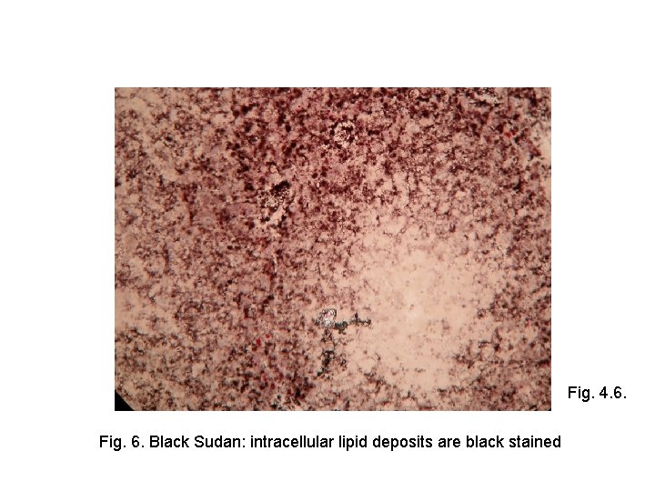 Fig. 4. 6. Fig. 6. Black Sudan: intracellular lipid deposits are black stained 