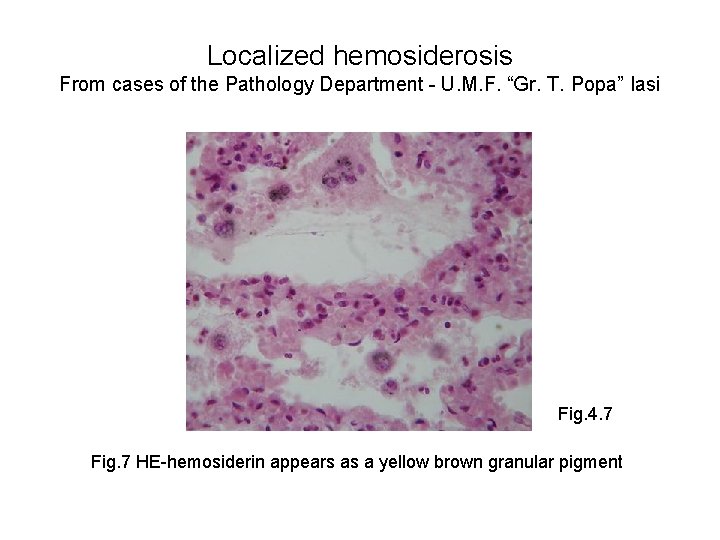 Localized hemosiderosis From cases of the Pathology Department - U. M. F. “Gr. T.
