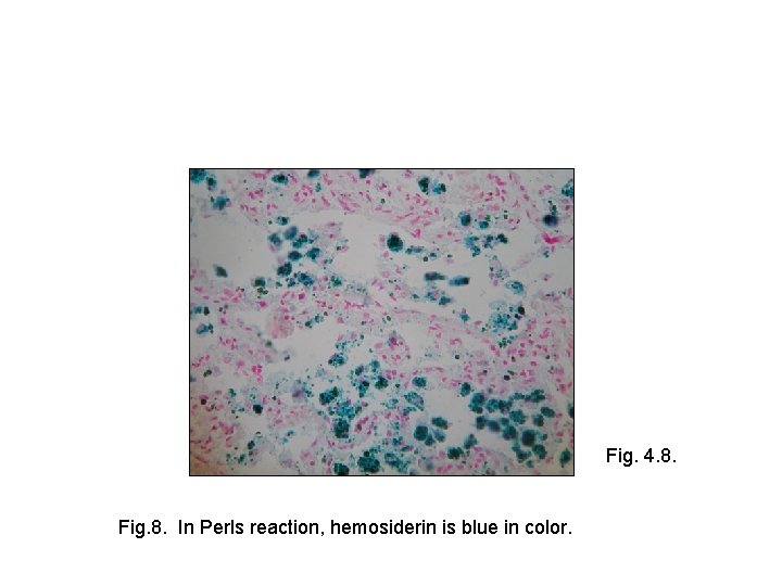 Fig. 4. 8. Fig. 8. In Perls reaction, hemosiderin is blue in color. 