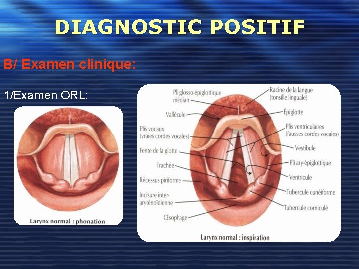 DIAGNOSTIC POSITIF B/ Examen clinique: 1/Examen ORL: 