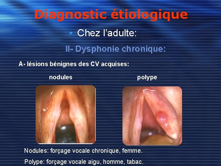 Diagnostic étiologique • Chez l’adulte: II- Dysphonie chronique: A- lésions bénignes des CV acquises: