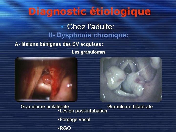 Diagnostic étiologique • Chez l’adulte: II- Dysphonie chronique: A- lésions bénignes des CV acquises: