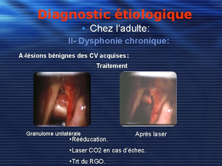 Diagnostic étiologique • Chez l’adulte: II- Dysphonie chronique: A-lésions bénignes des CV acquises: Traitement