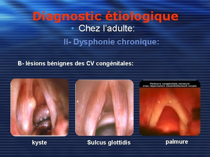 Diagnostic étiologique • Chez l’adulte: II- Dysphonie chronique: B- lésions bénignes des CV congénitales: