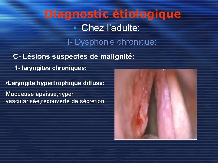 Diagnostic étiologique • Chez l’adulte: II- Dysphonie chronique: C- Lésions suspectes de malignité: 1