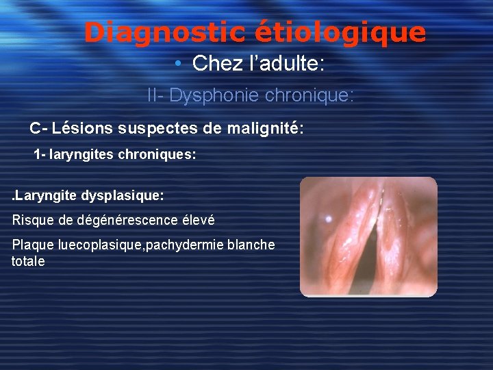 Diagnostic étiologique • Chez l’adulte: II- Dysphonie chronique: C- Lésions suspectes de malignité: 1