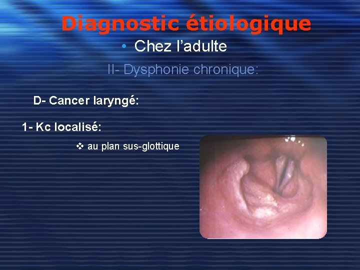 Diagnostic étiologique • Chez l’adulte II- Dysphonie chronique: D- Cancer laryngé: 1 - Kc