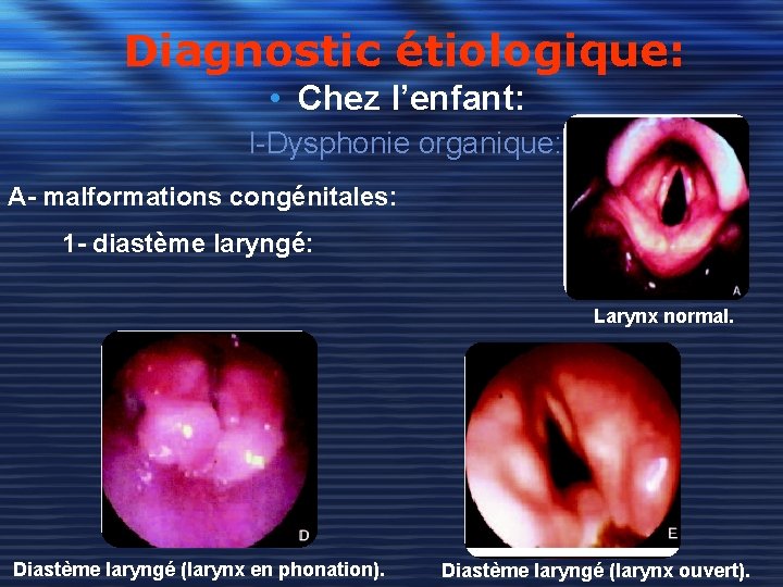 Diagnostic étiologique: • Chez l’enfant: I-Dysphonie organique: A- malformations congénitales: 1 - diastème laryngé: