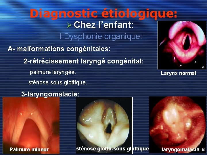 Diagnostic étiologique: Ø Chez l’enfant: I-Dysphonie organique: A- malformations congénitales: 2 -rétrécissement laryngé congénital: