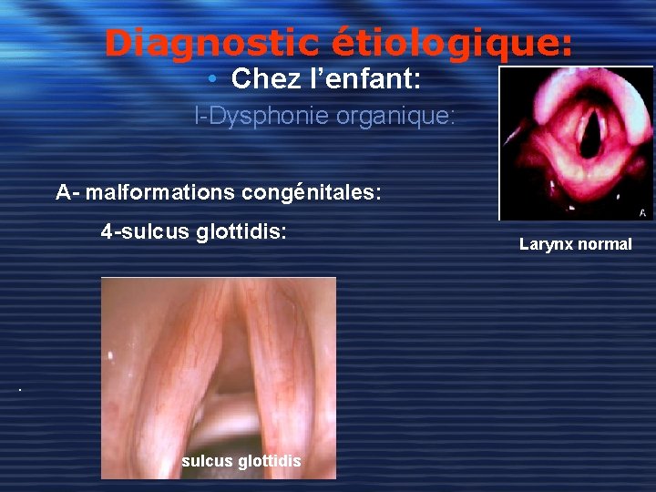 Diagnostic étiologique: • Chez l’enfant: I-Dysphonie organique: A- malformations congénitales: 4 -sulcus glottidis: .