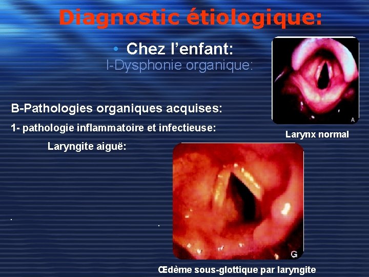 Diagnostic étiologique: • Chez l’enfant: I-Dysphonie organique: B-Pathologies organiques acquises: 1 - pathologie inflammatoire