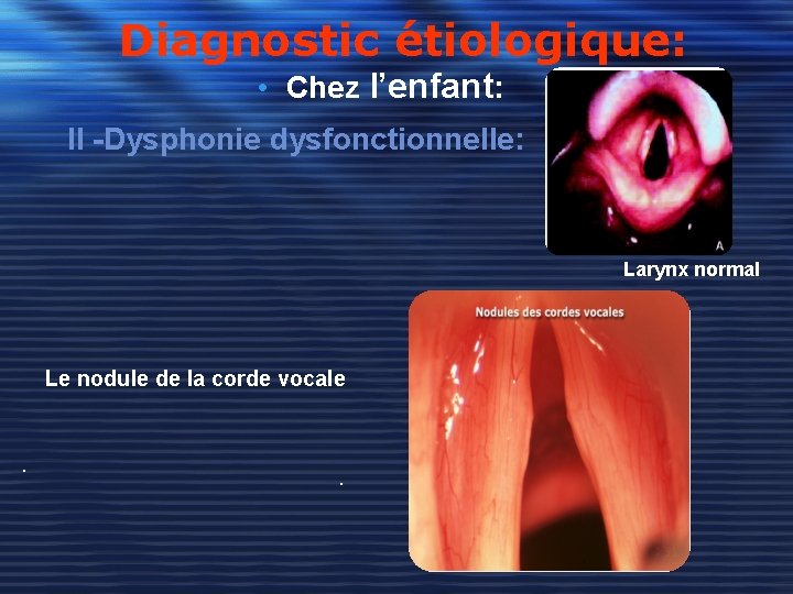 Diagnostic étiologique: • Chez l’enfant: II -Dysphonie dysfonctionnelle: Larynx normal Le nodule de la