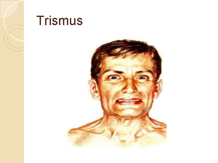 Trismus 