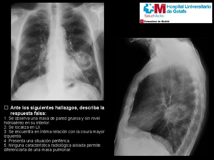 � Ante los siguientes hallazgos, describa la respuesta falsa: 1. Se observa una masa