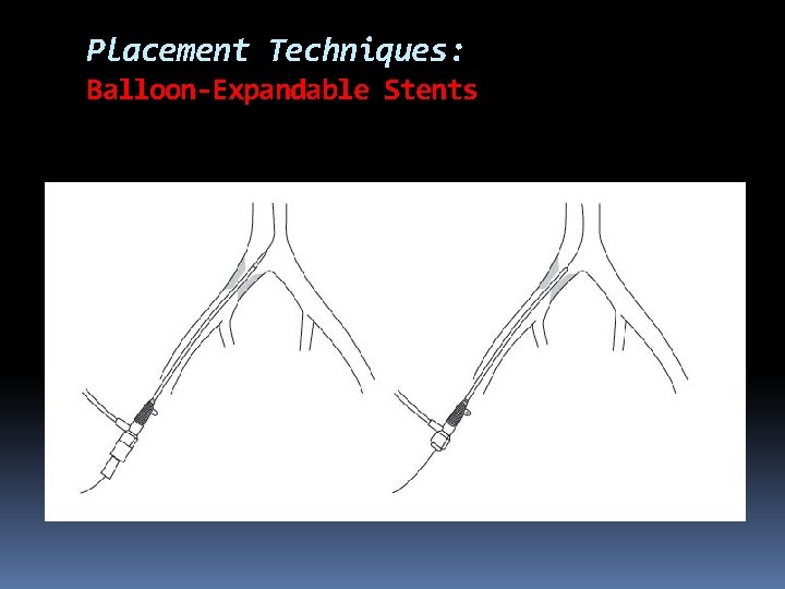 Placement Techniques: Balloon-Expandable Stents 