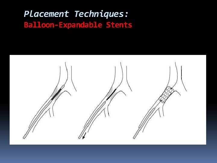 Placement Techniques: Balloon-Expandable Stents 