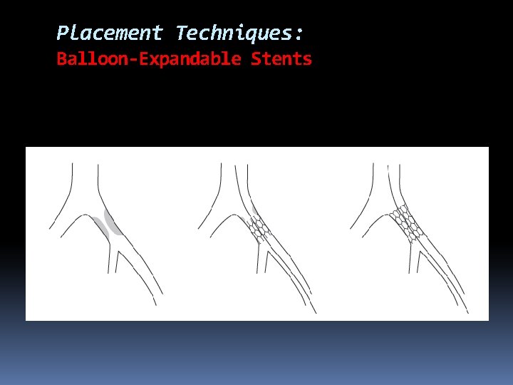 Placement Techniques: Balloon-Expandable Stents 