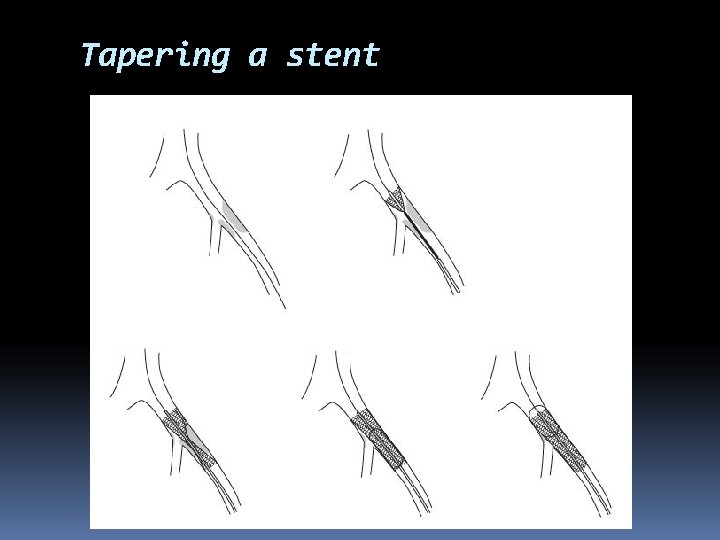 Tapering a stent 