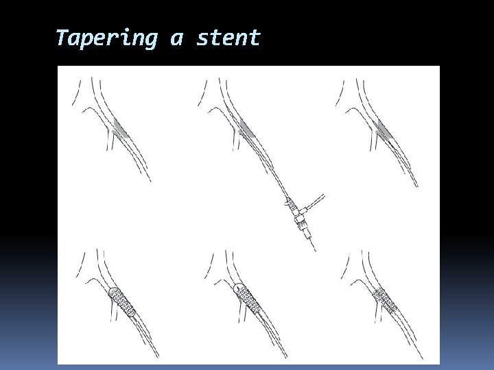 Tapering a stent 