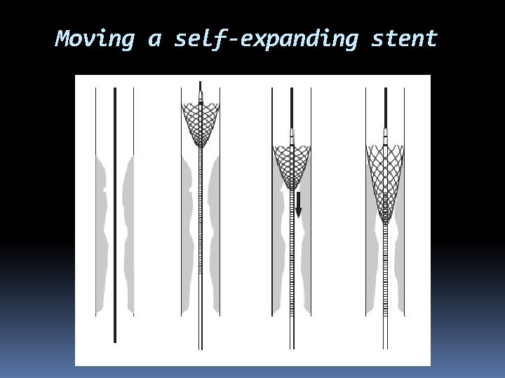 Moving a self-expanding stent 