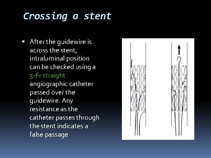 Crossing a stent After the guidewire is across the stent, intraluminal position can be