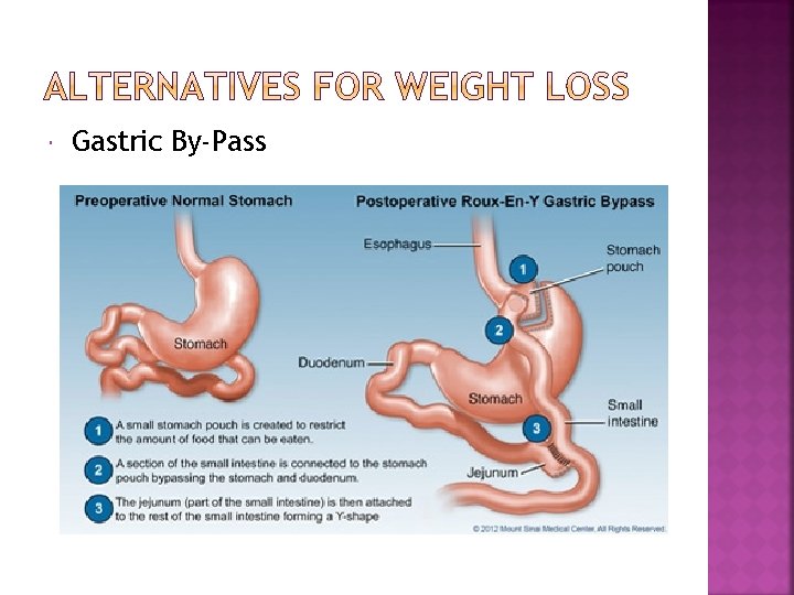  Gastric By-Pass 