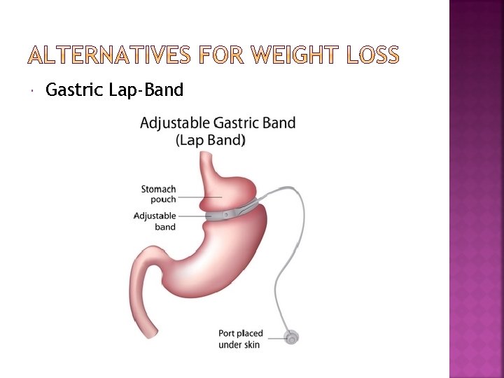  Gastric Lap-Band 