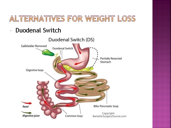  Duodenal Switch 