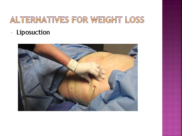  Liposuction 