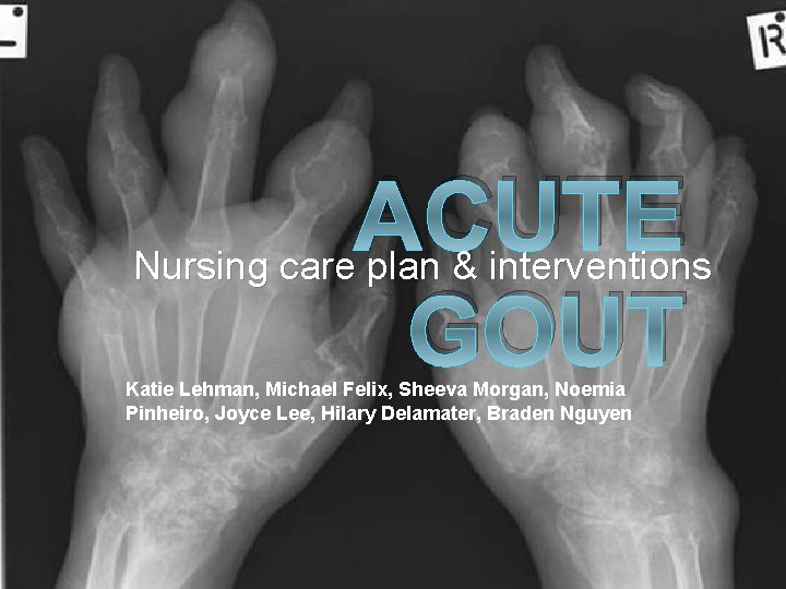 ACUTE Nursing care plan & interventions GOUT Katie Lehman, Michael Felix, Sheeva Morgan, Noemia