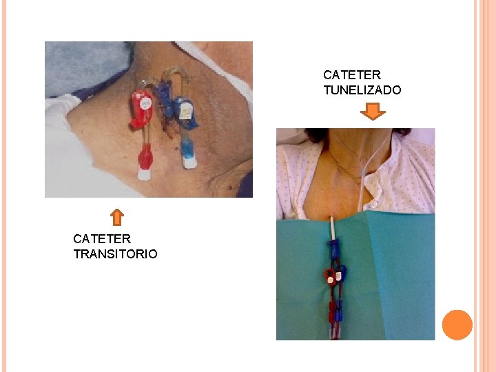 CATETER TUNELIZADO CATETER TRANSITORIO CATETER TUNELIZADO CATETER TRANSITORIO