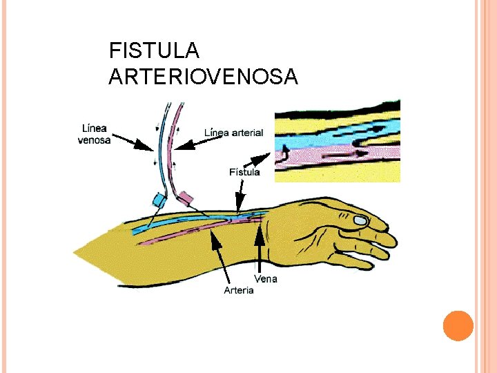 FISTULA ARTERIOVENOSA FISTULA ARTERIOVENOSA