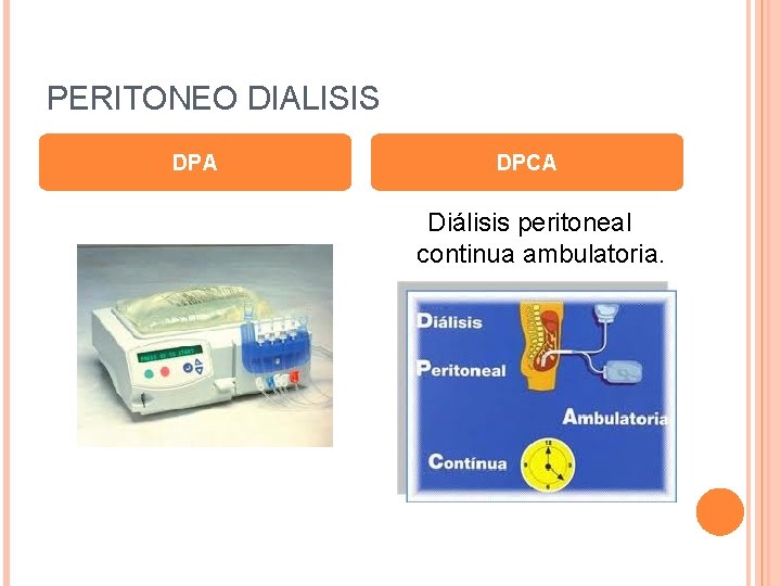 PERITONEO DIALISIS DPA DPCA Diálisis peritoneal continua ambulatoria. PERITONEO DIALISIS DPA DPCA Diálisis peritoneal continua ambulatoria.