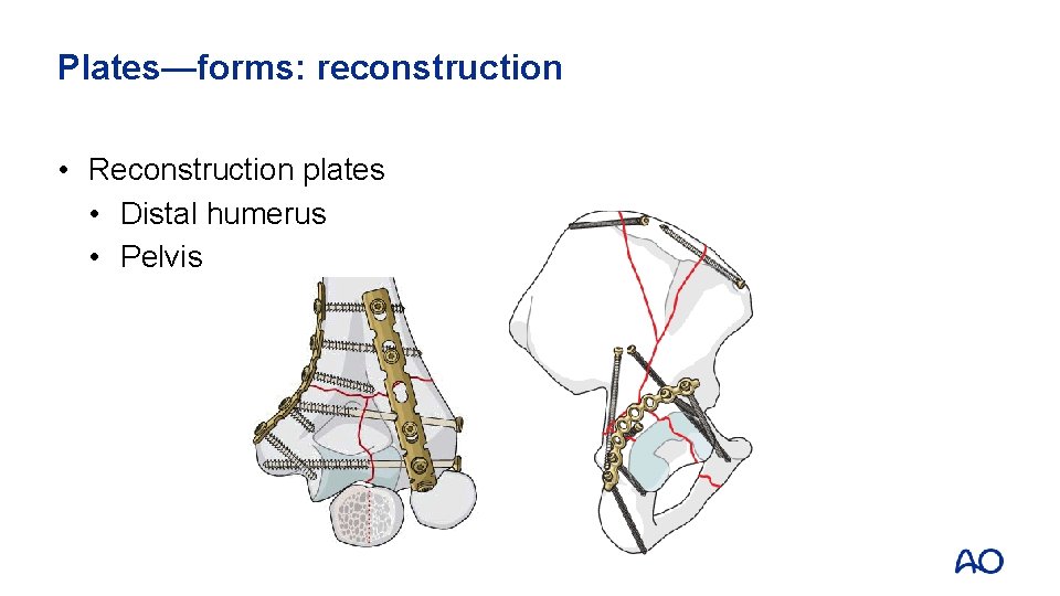Plates—forms: reconstruction • Reconstruction plates • Distal humerus • Pelvis 