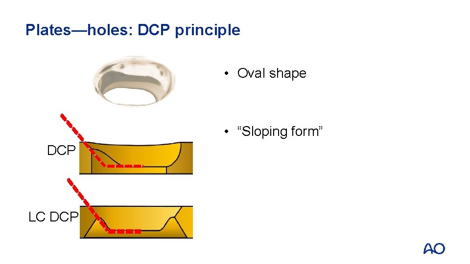 Plates—holes: DCP principle • Oval shape • “Sloping form” DCP LC DCP 