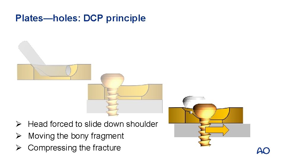 Plates—holes: DCP principle Ø Head forced to slide down shoulder Ø Moving the bony