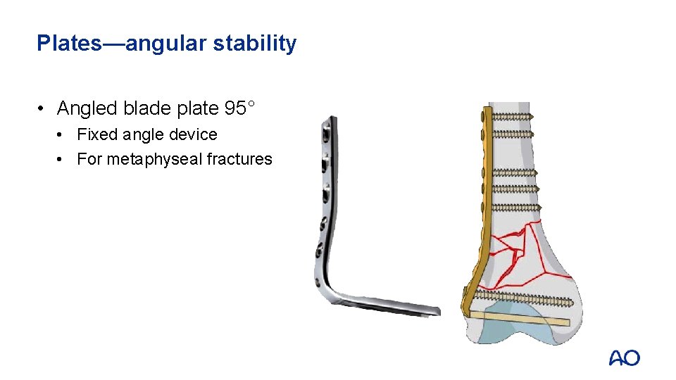 Plates—angular stability • Angled blade plate 95° • Fixed angle device • For metaphyseal